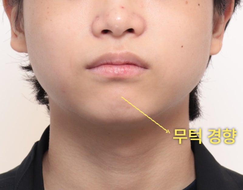 환자의 정면 얼굴 하단 사진. 턱 끝이 뒤로 들어가 보이는 무턱 경향을 보인다.