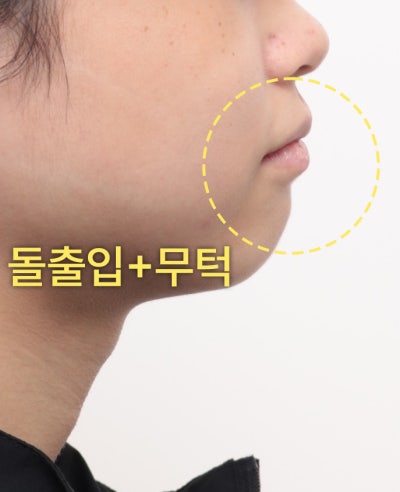 환자의 측면 얼굴 하단 사진. 입이 돌출되고 턱 끝이 뒤로 들어간 모습이다.