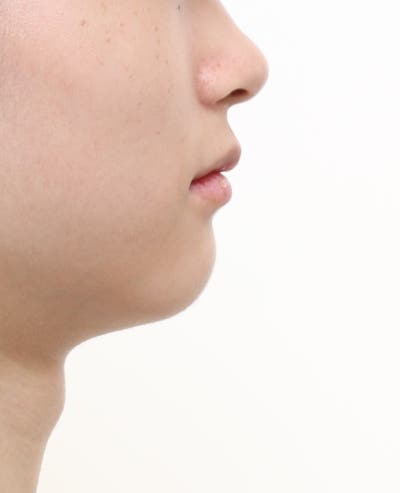 환자의 측면 얼굴 하단 사진. 교정 후 돌출입이 개선되고 턱 라인이 뚜렷해진 모습이다.