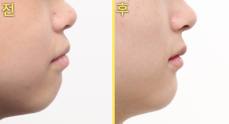 대구교정치과 혀 내미는 습관이 얼굴형을 바꿀 수 있나요? 관련 사진 21