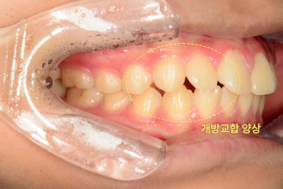 환자의 측면 치아 사진. 상악과 하악 앞니가 닿지 않는 개방교합 양상을 보인다.
