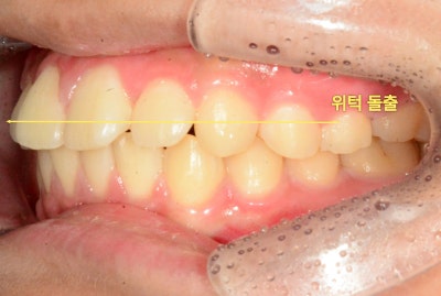 환자의 측면 치아 사진. 상악 앞니가 하악 앞니보다 앞으로 돌출된 모습이다.