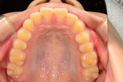 환자의 상악 치아를 위에서 내려다본 사진. 가지런한 치열을 보인다.