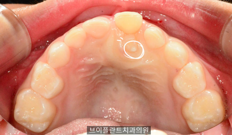 어린이 환자의 위턱 구강 내부 사진. 앞니 안쪽에 작은 과잉치가 보인다.