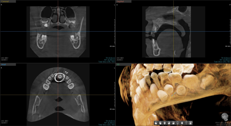 어린이 환자의 치아 CT 사진. 3D 이미지와 단면 이미지가 보인다.
