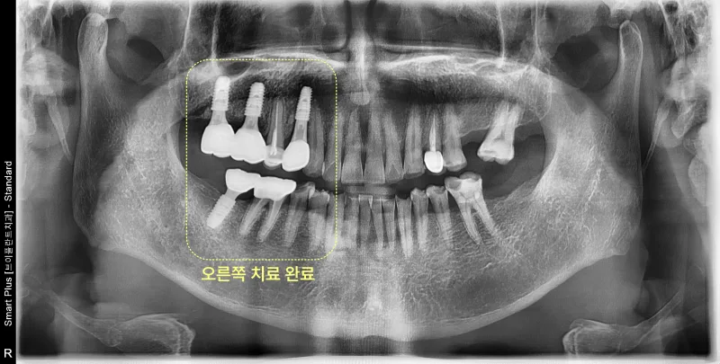 우측 상하악에 임플란트 보철물이 장착된 파노라마 방사선 사진
