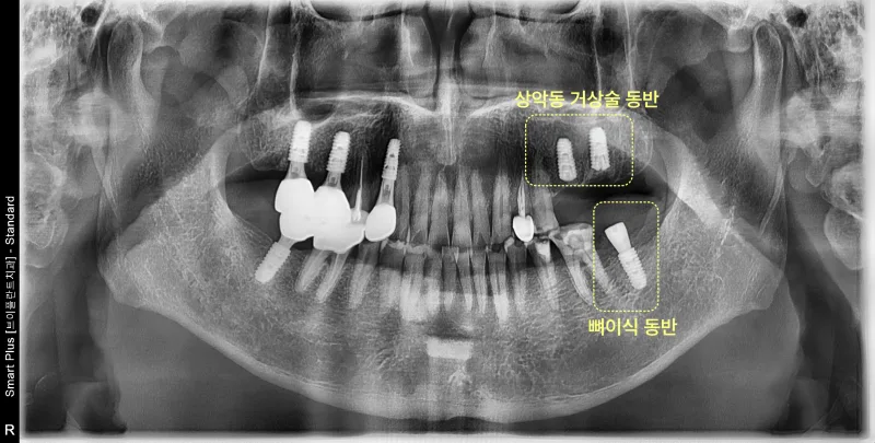 상악동 거상술과 뼈이식 동반 임플란트가 식립된 파노라마 방사선 사진