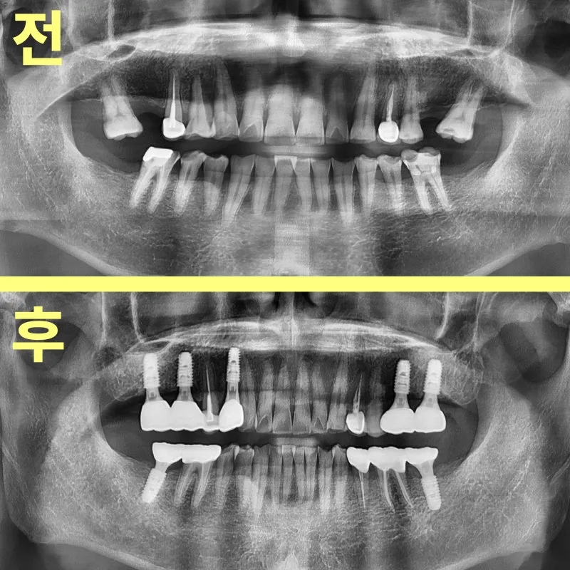 치료 전후 파노라마 방사선 사진 비교