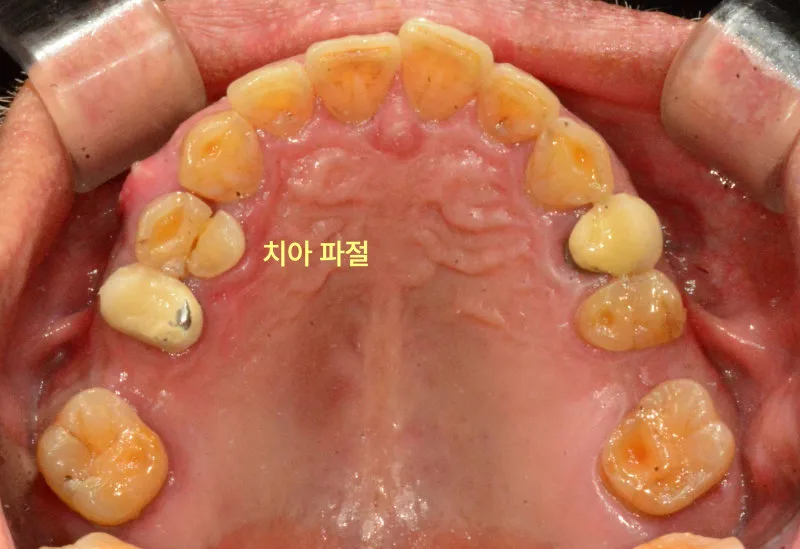 상악 치아의 심한 마모와 파절이 보이는 구강 내 사진