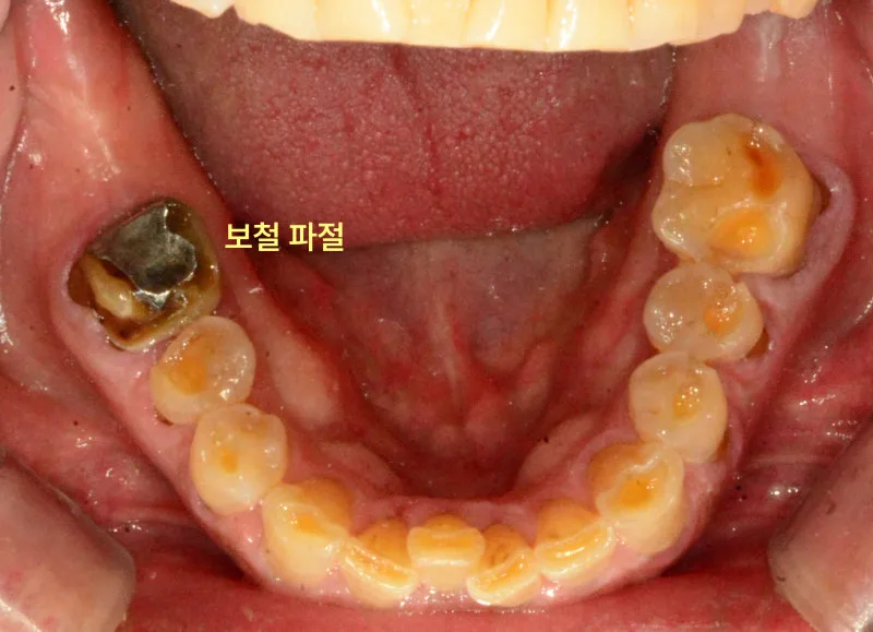 하악 치아의 심한 마모와 보철 파절이 보이는 구강 내 사진