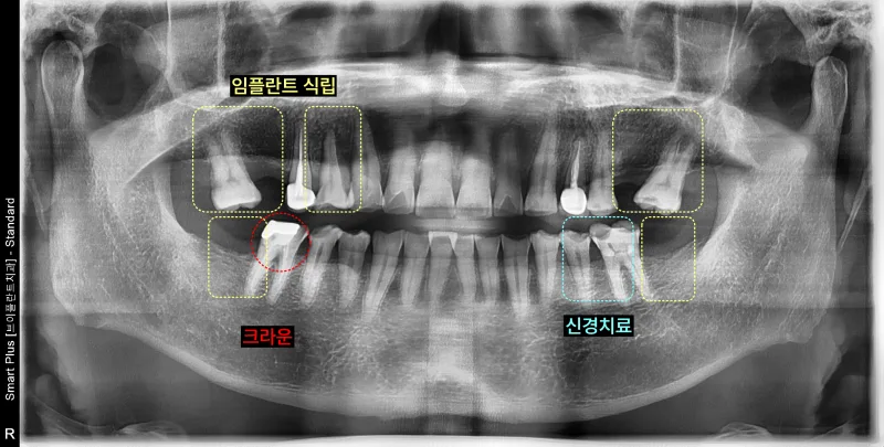 임플란트 식립, 크라운, 신경치료 부위가 표시된 파노라마 방사선 사진