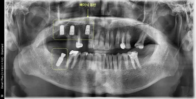상악 우측 어금니 부위에 뼈이식 동반 임플란트가 식립된 파노라마 방사선 사진