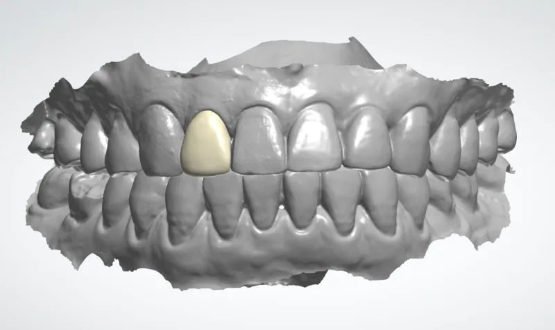 환자의 상하악 치아 3D 스캔 모델에 특정 치아를 노란색으로 표시한 이미지
