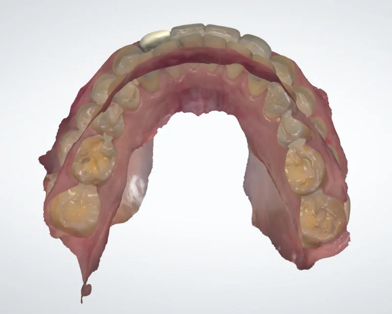 환자의 하악 치아를 3D 스캔한 교합면 모델 이미지
