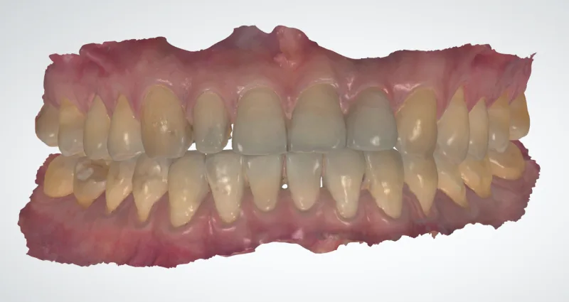 환자의 상하악 치아를 3D 스캔한 모델 이미지