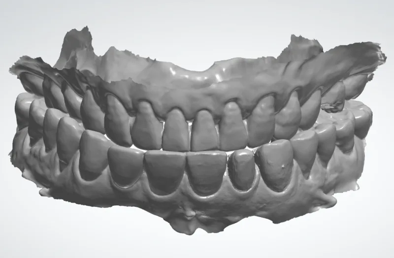 환자의 상하악 치아를 3D 스캔한 모델의 회색 음영 이미지