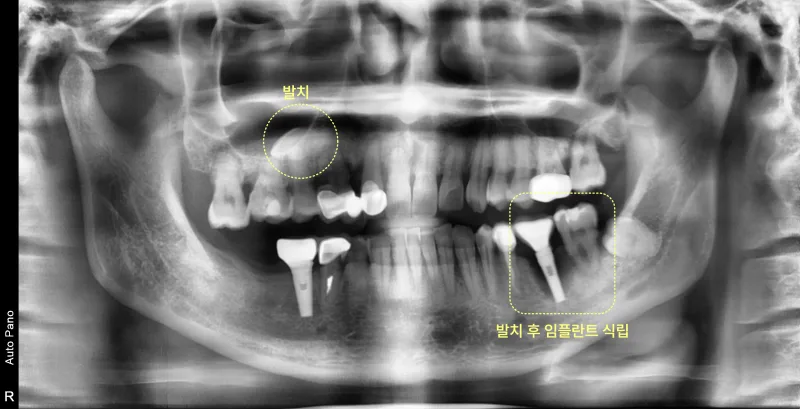 환자의 파노라마 방사선 사진, 상악 우측 매복치 발치와 하악 좌측 임플란트 발치 후의 모습