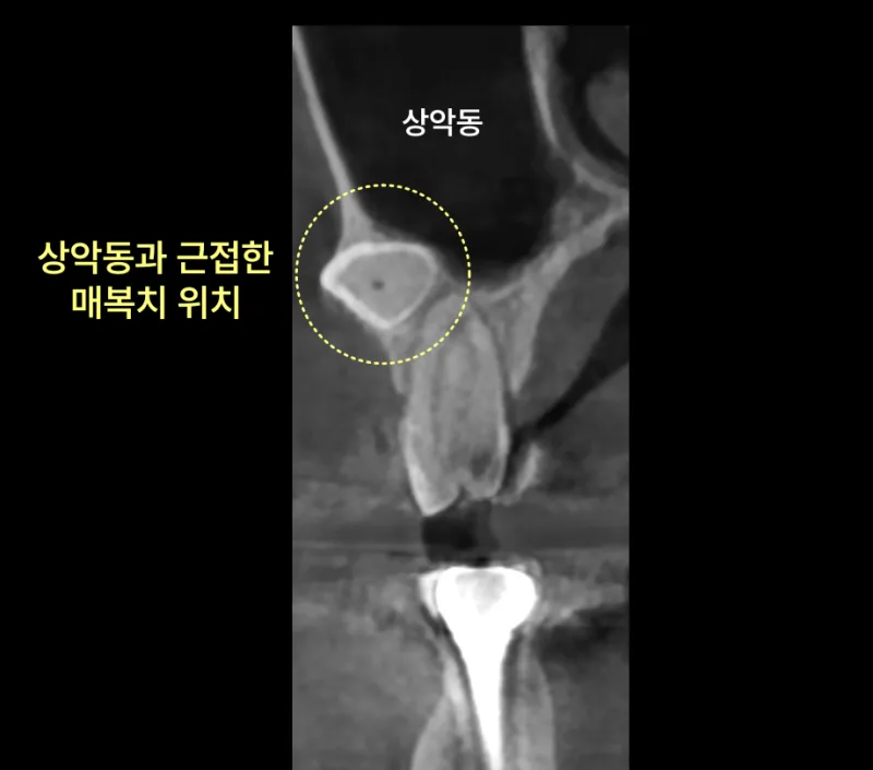환자의 상악동과 근접한 매복치 위치를 보여주는 CT 사진