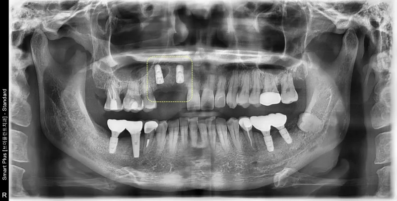 환자의 파노라마 방사선 사진, 상악 우측에 임플란트 2개가 식립된 모습이 보인다.