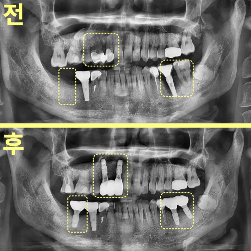 대구수성구치과 매복치 발치 판단 순서 관련 사진 25