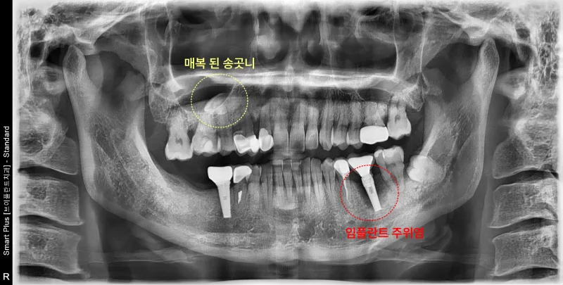 환자의 파노라마 방사선 사진, 상악 우측에 매복된 송곳니와 하악 좌측에 임플란트 주위염이 보인다.