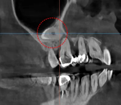 환자의 상악 우측 매복 송곳니를 측면에서 촬영한 CT 사진