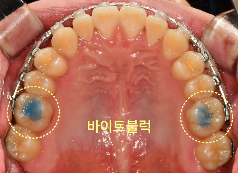 환자의 위턱 치아를 아래에서 위로 올려다본 사진으로, 어금니에 파란색 물질(바이트 블록)이 보인다.