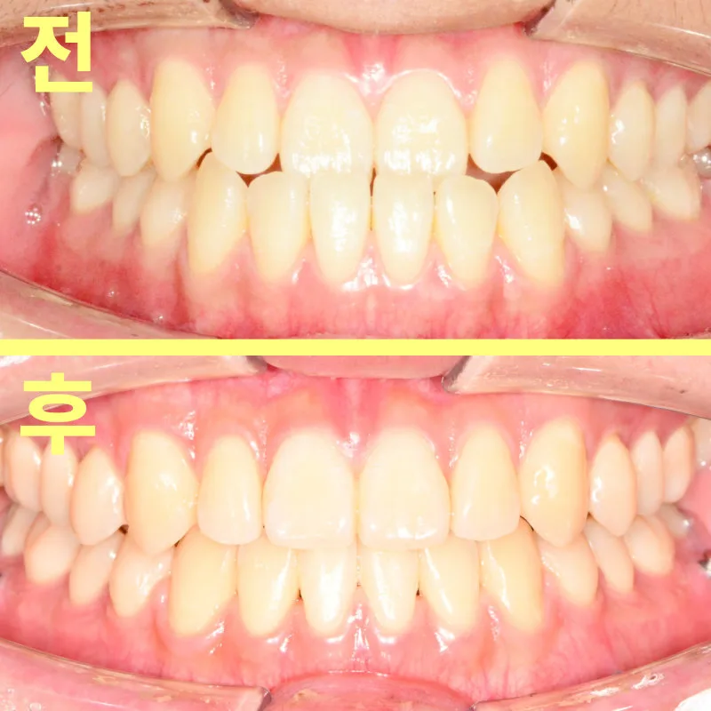 수성구치과 반대교합 수술만 답일까요? 관련 사진 30