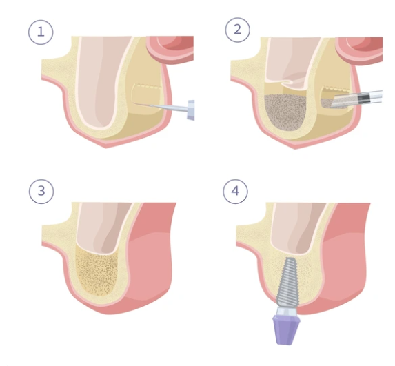 상악동 거상술 과정을 보여주는 4단계 일러스트