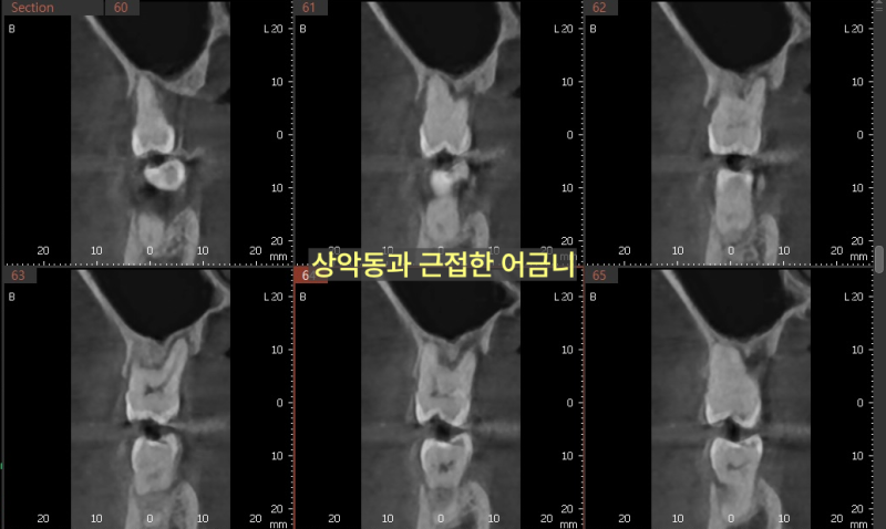 상악동과 근접한 어금니 부위의 CT 단면 사진 6장