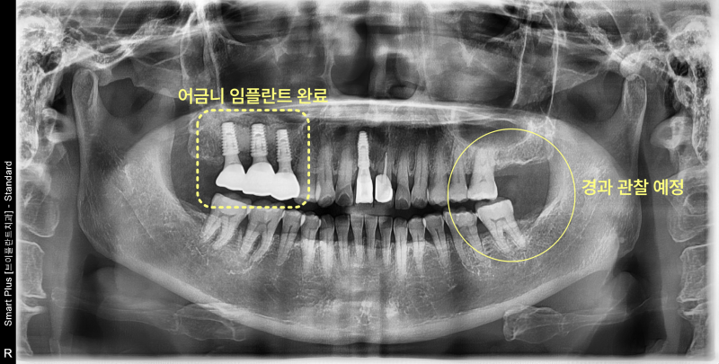 어금니 임플란트 완료 및 우측 치아 경과 관찰 예정인 파노라마 방사선 사진