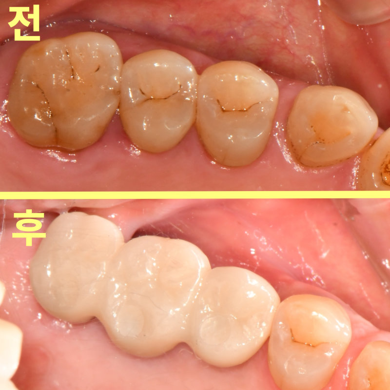 수성구치과 발치 후 빈자리 언제 메워야 할까요? 관련 사진 22