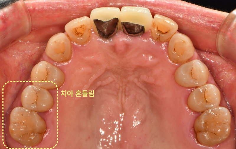 상악 치아의 교합면을 촬영한 구강 내 사진으로, 좌측 어금니의 흔들림을 표시