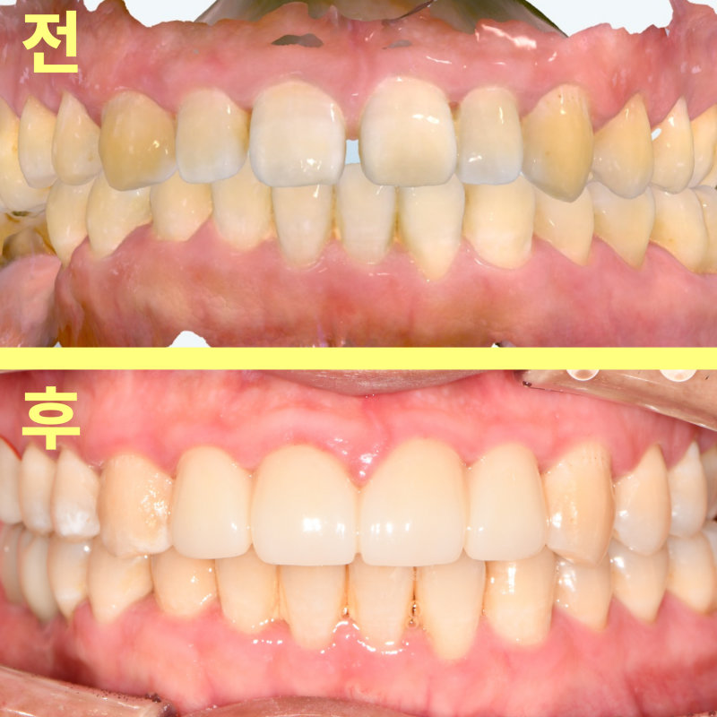 치료 전후 상악 전치부 구강 내 정면 사진 비교