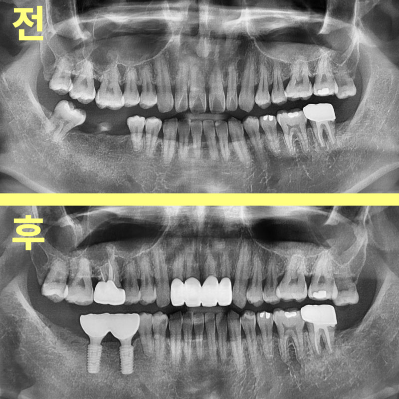 치료 전후 파노라마 방사선 사진 비교