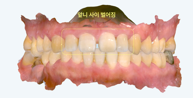 앞니 사이가 벌어진 치아 모형 사진