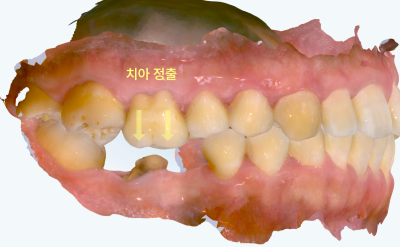치아 정출이 일어난 치아 모형 사진