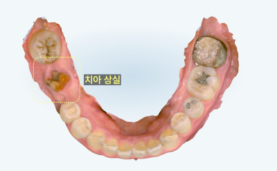 치아가 상실된 하악 치아 모형 사진
