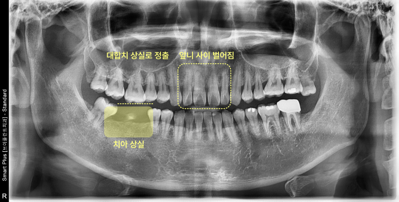 치아 상실, 치아 정출, 앞니 벌어짐이 보이는 파노라마 방사선 사진