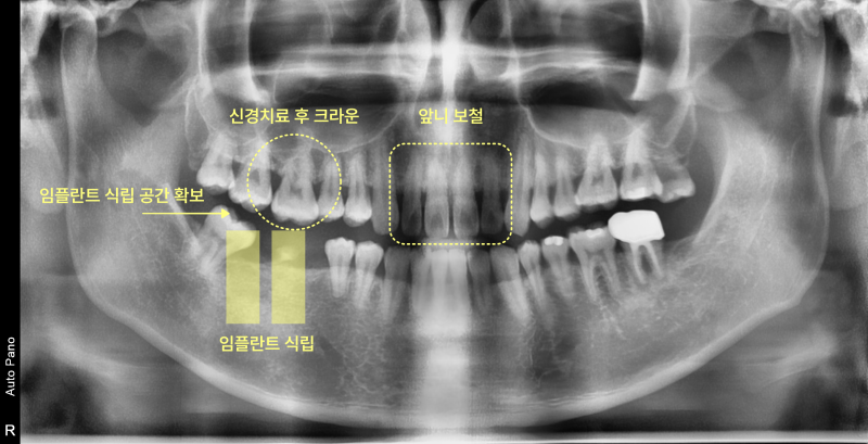 임플란트 식립 공간 확보, 임플란트 식립, 신경치료 후 크라운, 앞니 보철 계획이 표시된 파노라마 방사선 사진