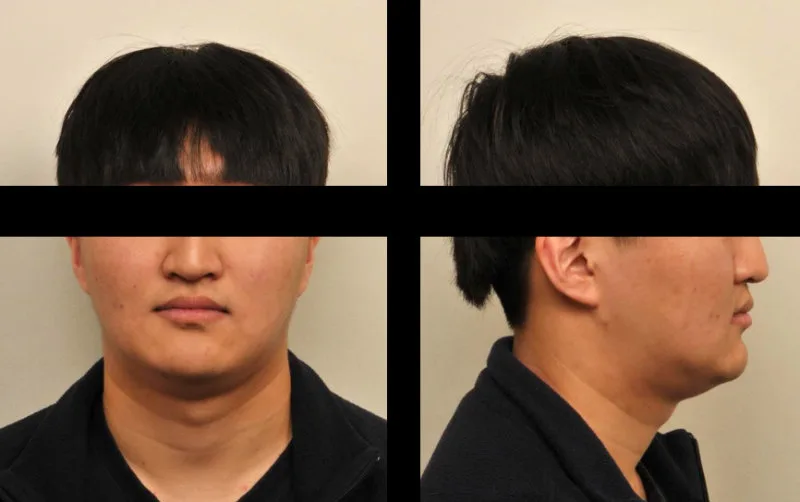 치아 교정 후 정면 및 측면 얼굴 사진