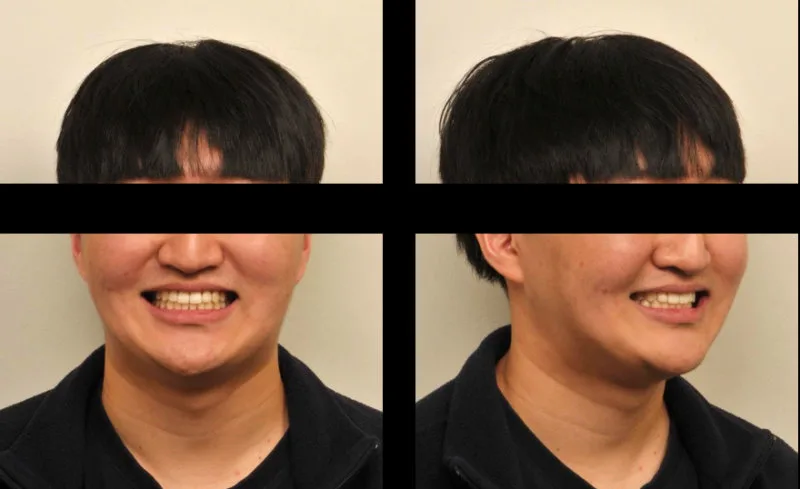 치아 교정 후 웃는 모습의 정면 및 측면 얼굴 사진