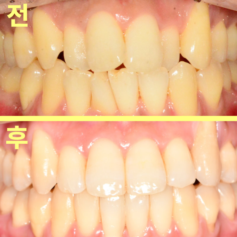 환자 정면 구강 내 사진: 교정 전후 비교