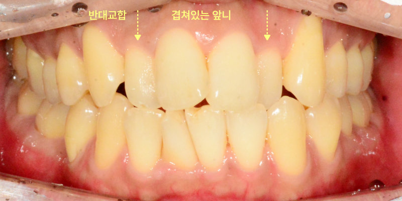 환자 정면 구강 내 사진: 반대교합과 겹쳐진 앞니