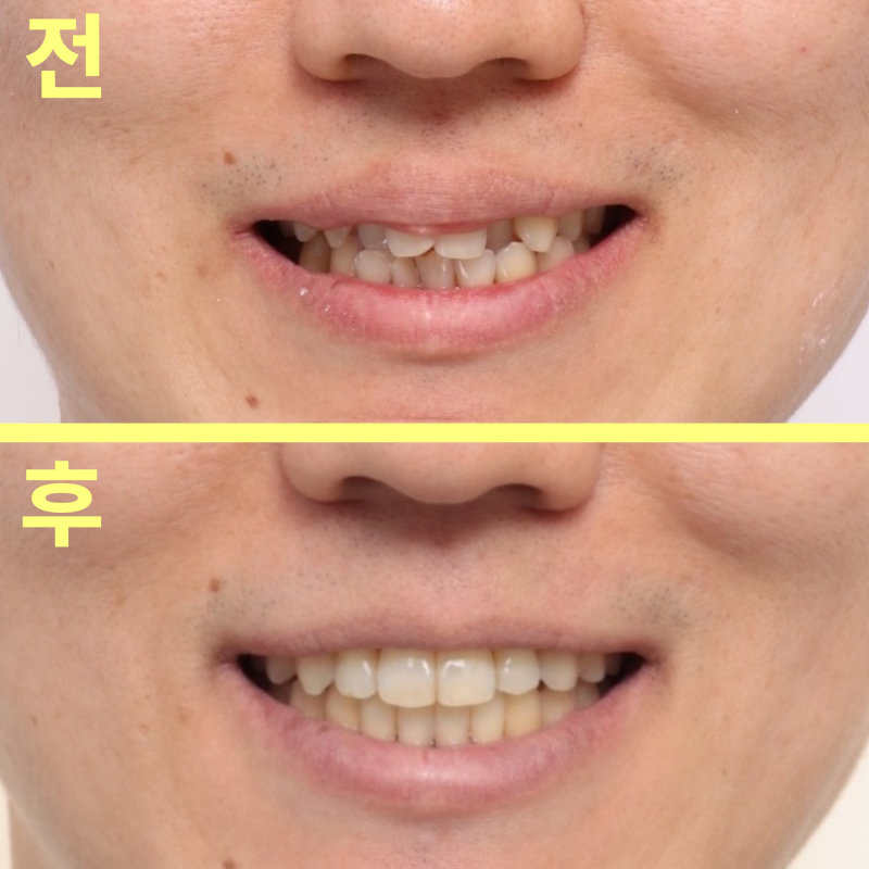 수성구치과 튀어나온 앞니 비발치 교정이 될까요? 관련 사진 21