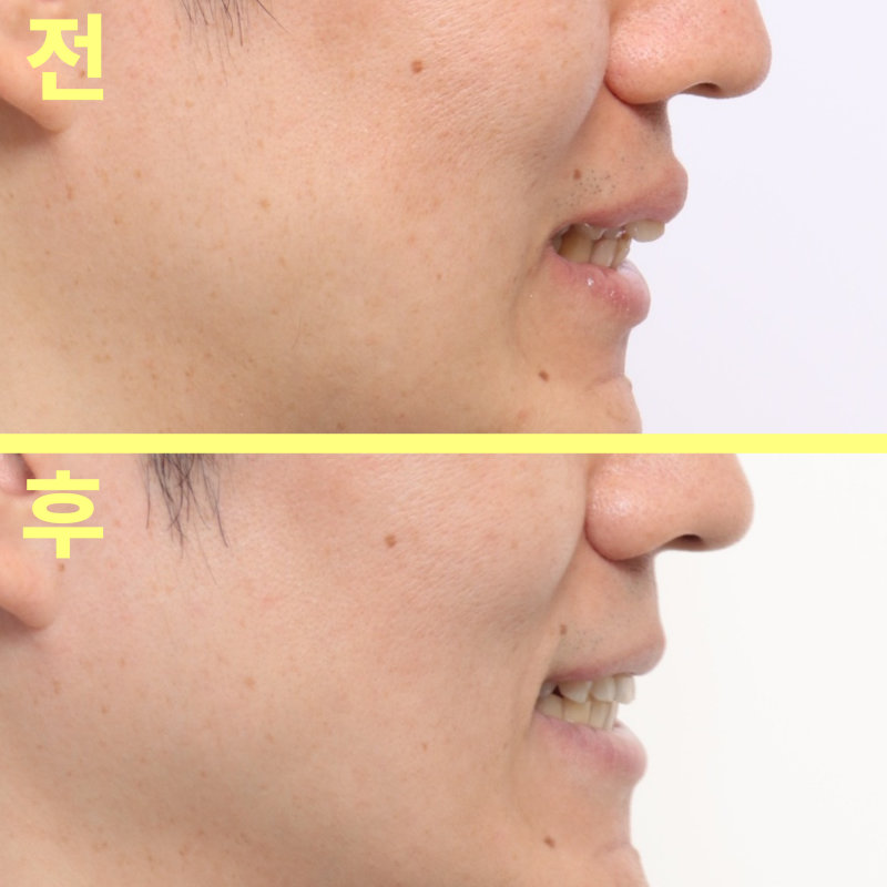 수성구치과 튀어나온 앞니 비발치 교정이 될까요? 관련 사진 22