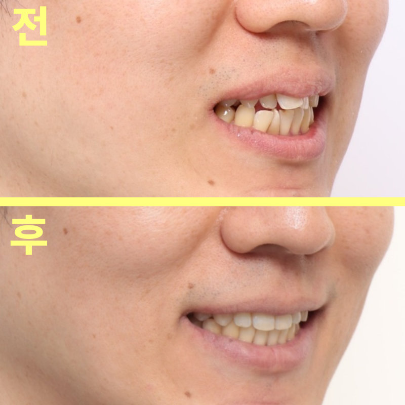 수성구치과 튀어나온 앞니 비발치 교정이 될까요? 관련 사진 23
