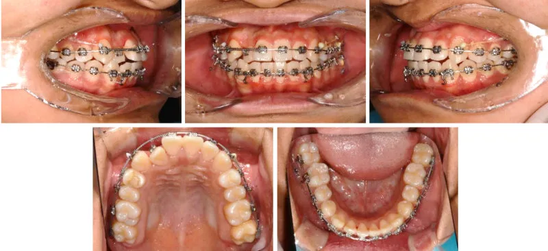 치아 교정 진행 중 구강 내 치아 사진