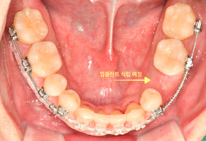 성인 환자의 하악 구강 내면 사진, 교정 장치 부착 및 임플란트 식립 예정 부위 표시