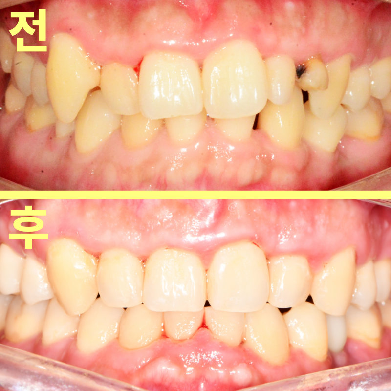 성인 환자의 교정 전후 전치부 구강 내 비교 사진